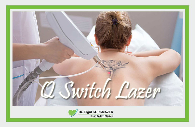 Q Switch Lazer